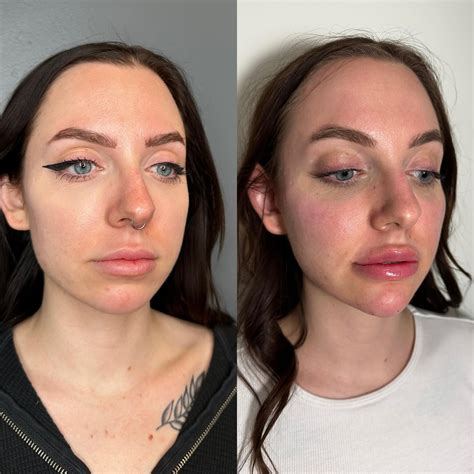 Dissolved the lips then refilled them, also did cheek and chin filler ...