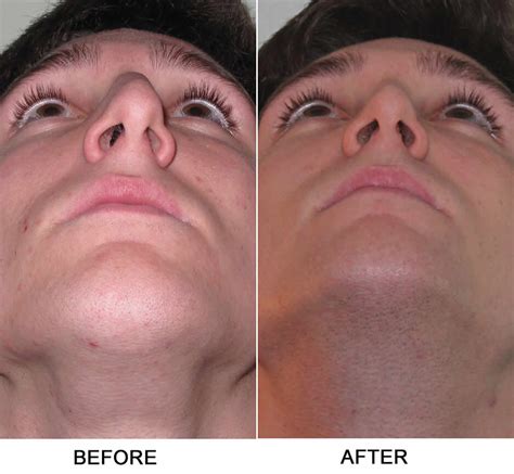 Can Nasal Strips Help Deviated Septum at William Ribush blog