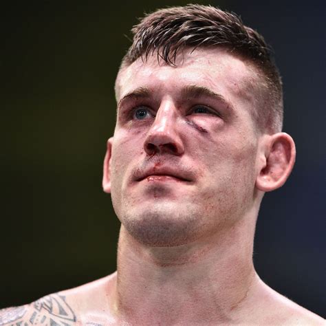 Fractured Orbital Bone