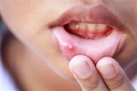 Canker Tongue Sores Treatment