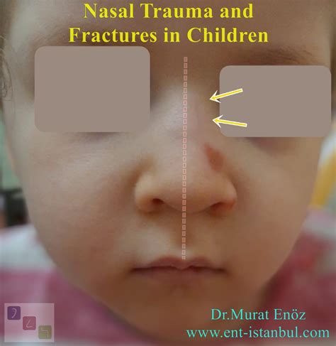 Nasal Fractures - Causes, Symptoms, Diagnosis, Treatment