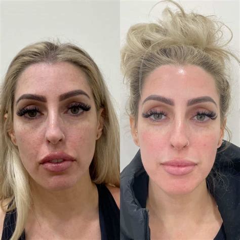 9 Amazing PRP Facial Benefits - the daily glimmer