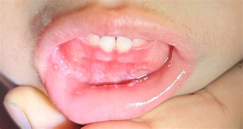 Primary Herpetic Gingivostomatitis - Dr Ellie Nadian