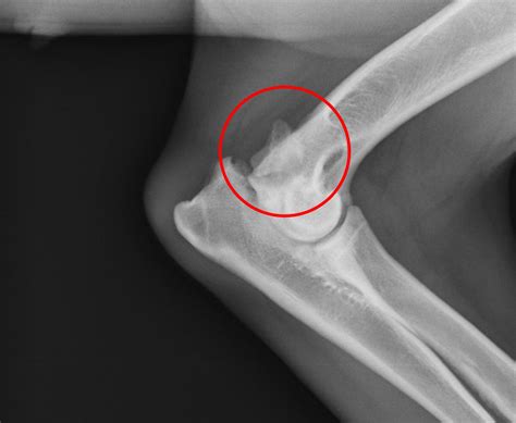 Elbow Olecranon Fractures Orthoinfo Aaos