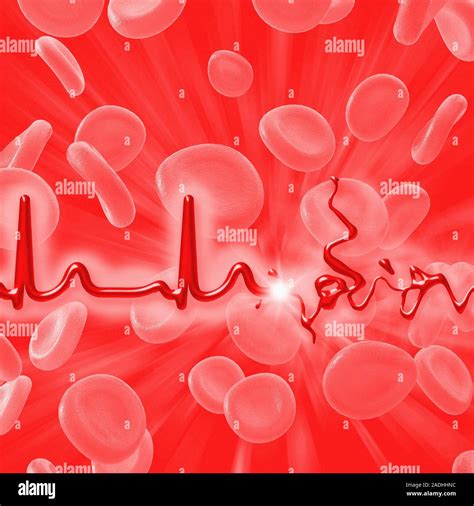 Ruptured blood vessel. Computer artwork of an electrocardiogram (ECG ...