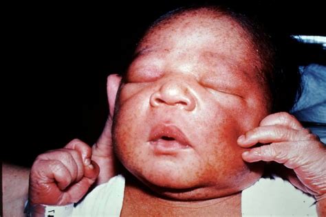 Neonatal Pustular Melanosis