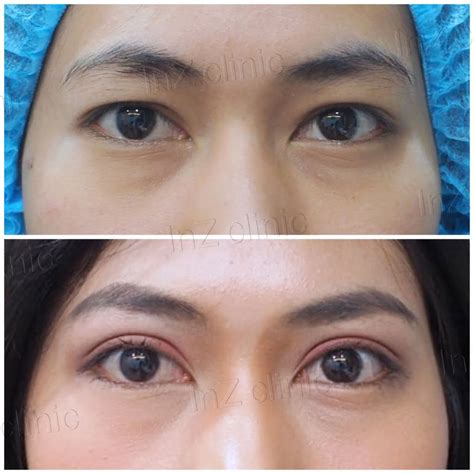 Current methods of double eyelid surgery, pros & cons - inZ Clinic