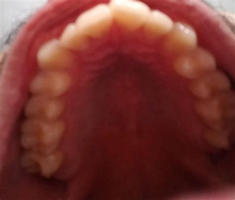 Is this a wide palate or a narrow one ?? : r/orthotropics