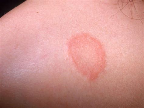 Ringworm, tinea, causes, signs, symptoms, diagnosis & treatment