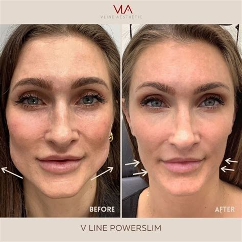 Non-Surgical Face Slimming - V LINE AESTHETICS