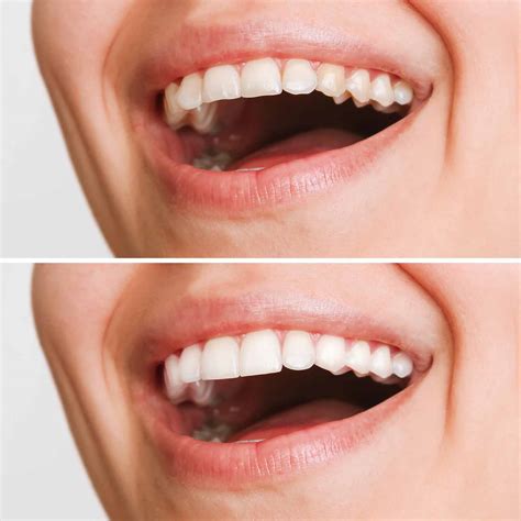 Dental Crown Vs Veneer
