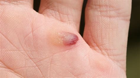 What are the Causes, Symptoms, and Treatment of Blood Blisters?