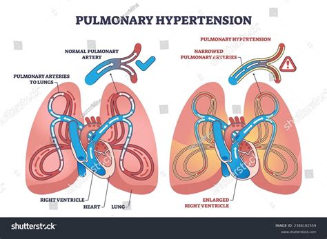 Pulmonary Hypertension Narrow Arteries Blockage Outline Stock Vector ...