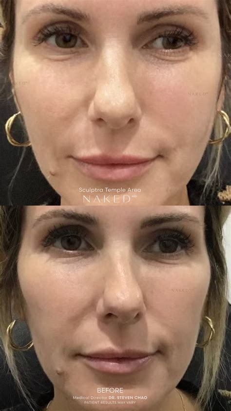 Sculptra® Filler & Injections in California and Arizona – NAKEDMD Medspa