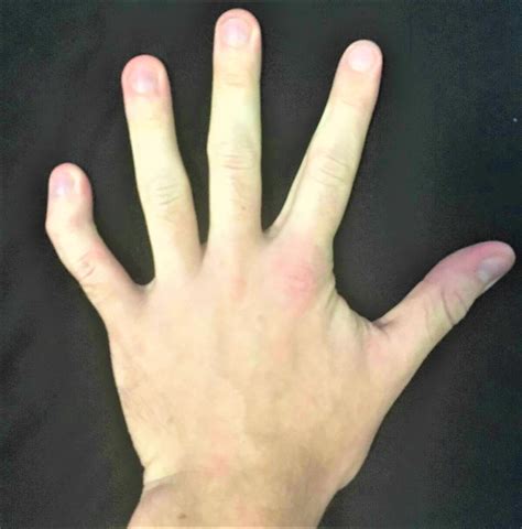 Triple X Syndrome
