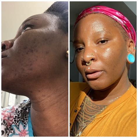 Best Acid For Hyperpigmentation Dark Skin at Wilma Scanlon blog