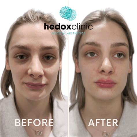 Facial Asymmetry Treatment London - Hedox Clinic