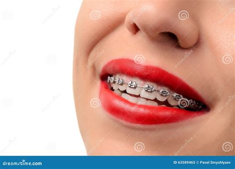 Female Open Mouth Showing Metal Braces Stock Image - Image of happiness, human: 63589465