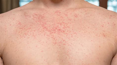 Rote Punkte auf der Haut: Das sind die Ursachen - CHIP