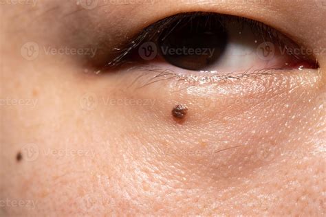 mole under the eyes of a man, pigmentation on the face 8902293 Stock ...