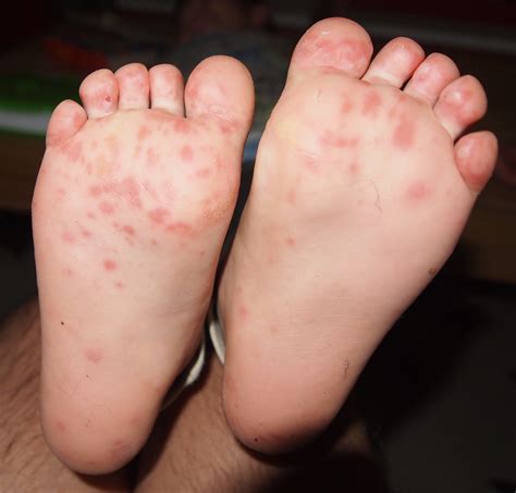 File:Hand foot and mouth disease on child feet.jpg