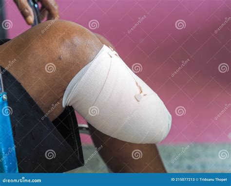 Elastic Bandaged Below Knee Amputation Stock Image - Image of care ...