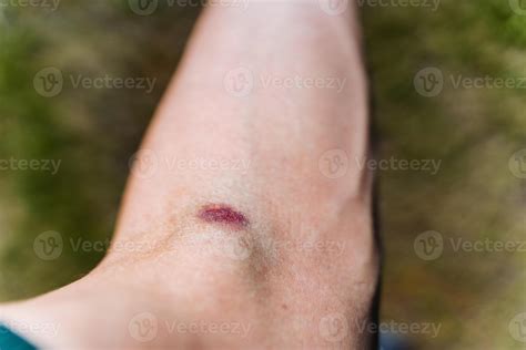 Documenting the gradual healing process of a bruise on the arm, this ...