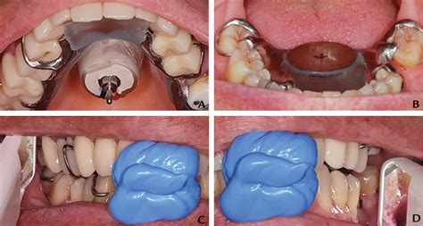 A digital, custom gothic arch tracing technique for vertical dimension ...