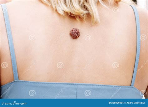 Verruga. 6.º Mole. Gran Verruga En La Piel. Enfermedad De La Piel Tumor ...