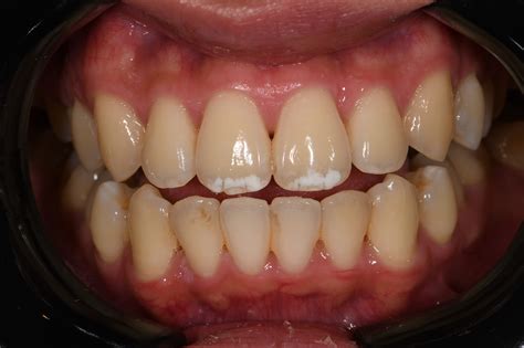 White Treatment Teeth at William Long blog