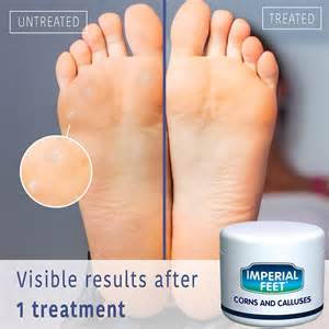 Ultra Effective Foot Callus Corn Remover with Salicylic Acid | Foot Cream for Hard Dry Skin ...