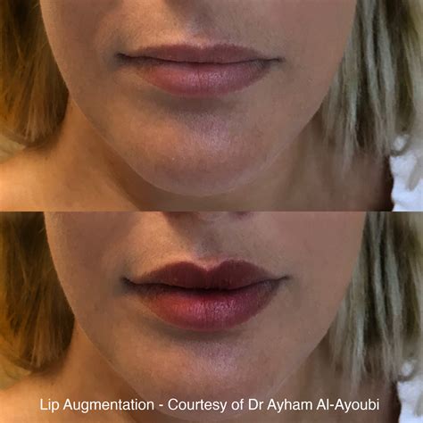 Fat Transfer To Lips Before And After | Lipstutorial.org
