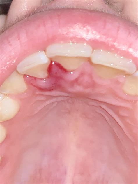 Swollen tissue underneath filtrum : r/Dentistry