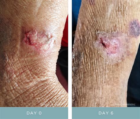 Wound Care for Diabetics Before + After