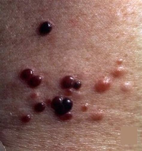 Metastatic stage 4 melanoma, life expectancy & metastatic melanoma ...