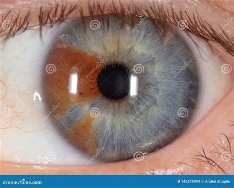 Birthmark on the eye stock photo. Image of brown, shell - 146575994