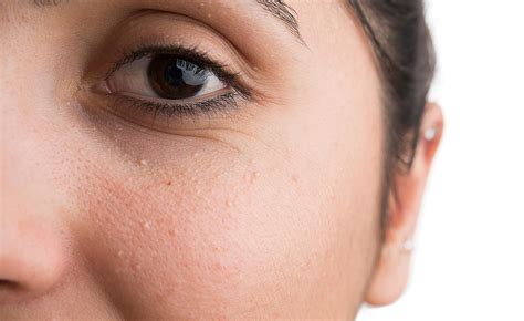 How To Treat Milia—the Tiny White Bumps on Your Face | Beautylish