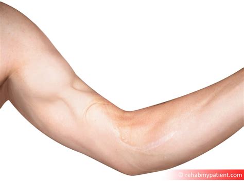 Rupture Tendon Biceps , Distal biceps tendon injury – CWPVCQ