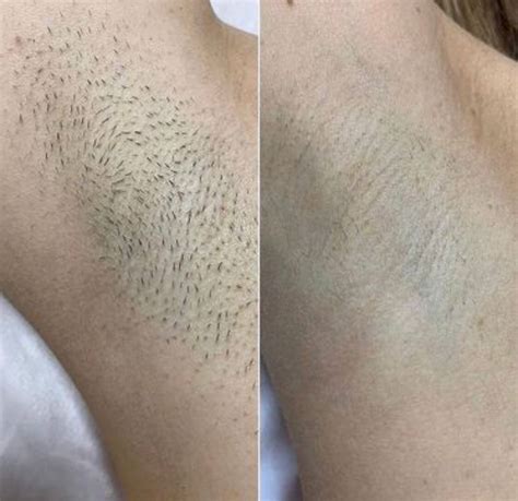 Laser Pubic Hair Removal Permanent at Gail Pagano blog