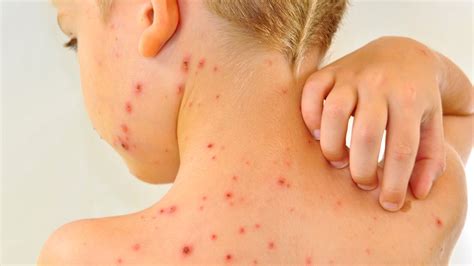 Giving children chickenpox vaccine 'could end risky pox parties ...