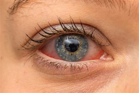 How to Prevent Eye Damage From Diabetes