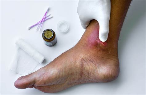 Técnicas para el tratamiento de los abscesos - Mejor con Salud