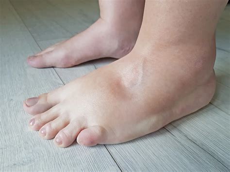 Is Heat Edema Dangerous? Understanding Swelling in Miami's Heat ...