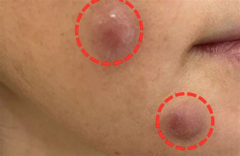 Avoid Thread Lift Gone Wrong from Diaminy Supplier