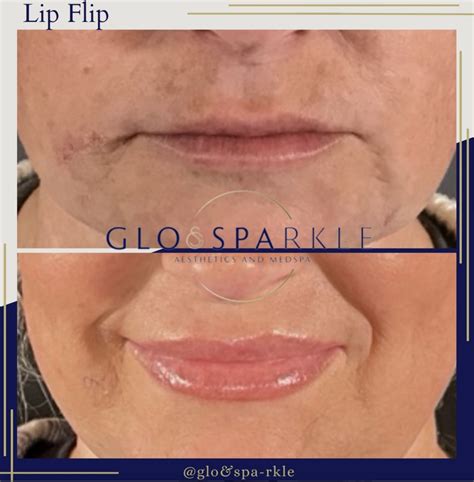 Lip Flip Before & After Photos in Lubbock, TX | Glo & Sparkle