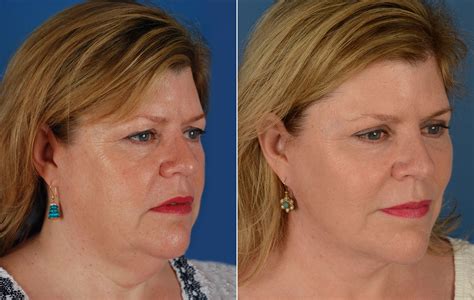 Vertical Lower Face Lift at Jayne Griffin blog