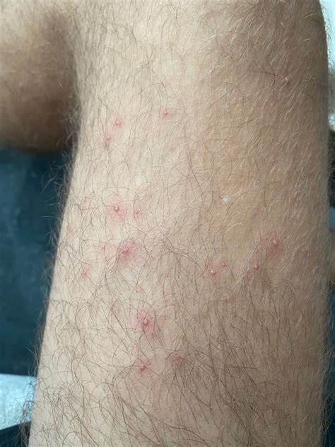 Pimple like bumps appeared in my legs overnight, does anybody know what it is? : r/Dermatology