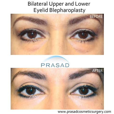 Blepharoplasty before after online