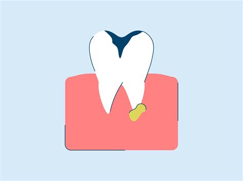 Tooth Abscess: Stages, Symptoms & Treatment
