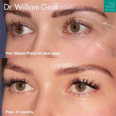 Facial Vein Removal Medi Spa | San Diego, CA | CLDerm